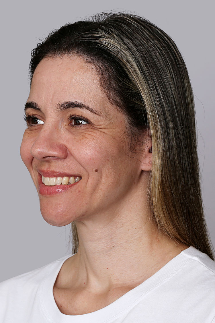 Sculptra Tracy After 12 Months Sm