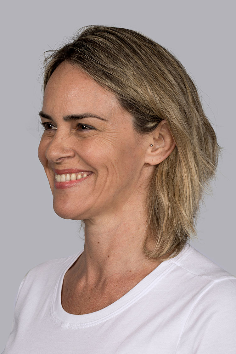 Sculptra Viviane Before Sm