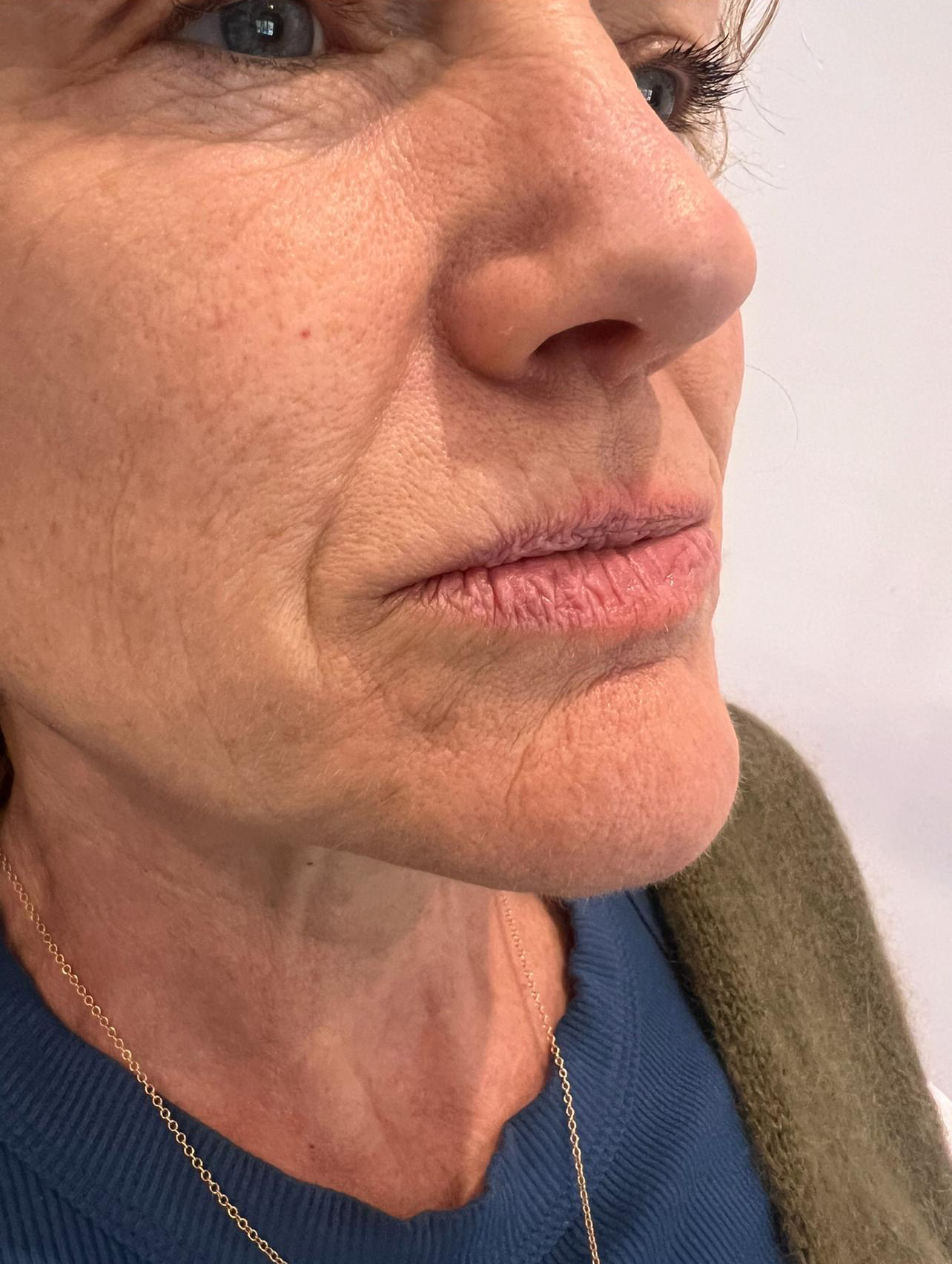 Lip Refreshment Before 2 Cut